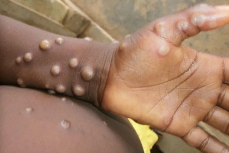 多國報告首宗猴痘確診病例
 世衛預計全球將出現更多