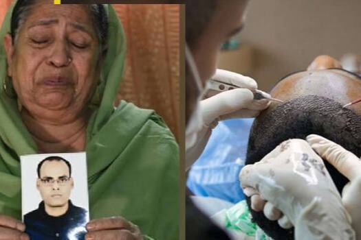 為想結婚做植髮手術 印度30歲禿頭男「器官衰竭」慘死