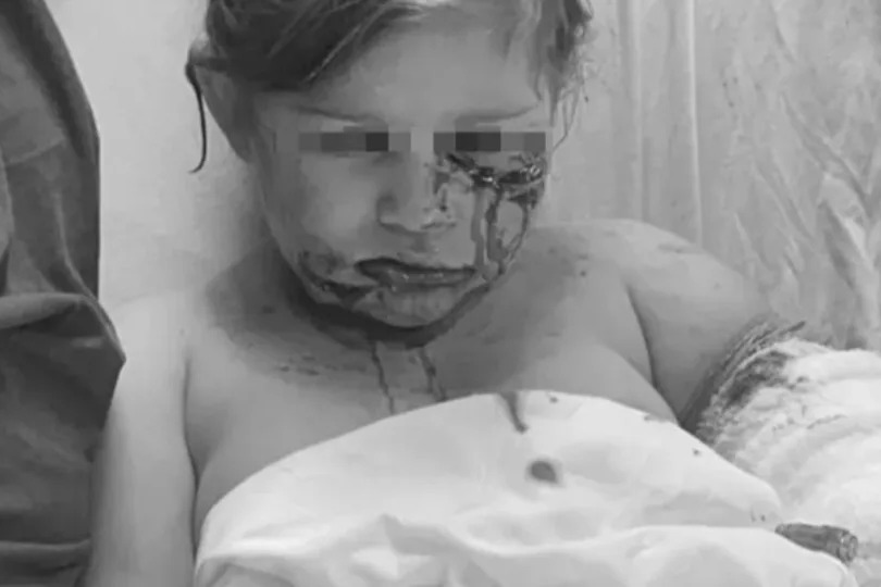 3歲女童被領養狗咬爛半邊臉 肌肉損傷嚴重無法微笑
