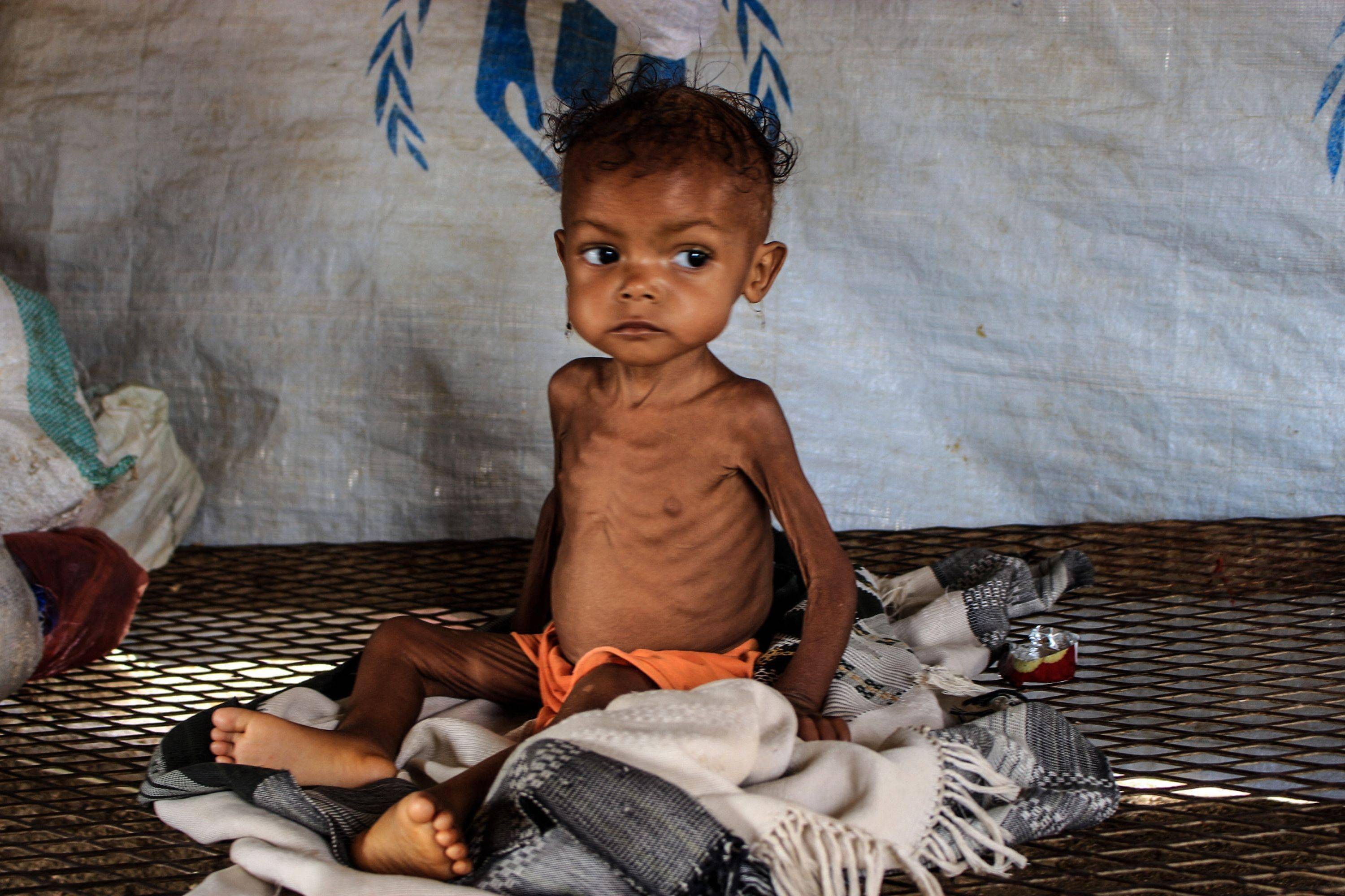 也門面臨嚴重饑荒
 孩童骨瘦如柴令人心碎